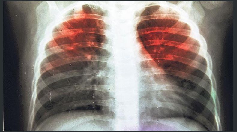 La tuberculosis es una enfermedad bacteriana que ataca principalmente los pulmones. Se propaga con mayor facilidad entre personas con otras enfermedades previas y de gravedad, como el VIH, la insuficiencia renal y la diabetes