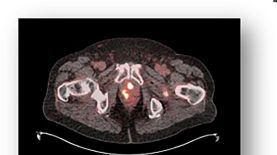 ARCHIVO -Imagen de una próstata con signos de cáncer. Los hombres latinos enfrentan tasas elevadas de cáncer de próstata en Estados Unidos, siendo la cuarta causa de muerte por cáncer en esta población. Foto: AP.