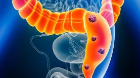 El alimento que ayuda a disminuir el cáncer de colon. Foto: iStock