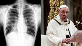 El papa Francisco fue diagnosticado con neumonía bilateral ¿qué es esta enfermedad?