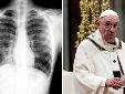 El papa Francisco fue diagnosticado con neumonía bilateral ¿qué es esta enfermedad?